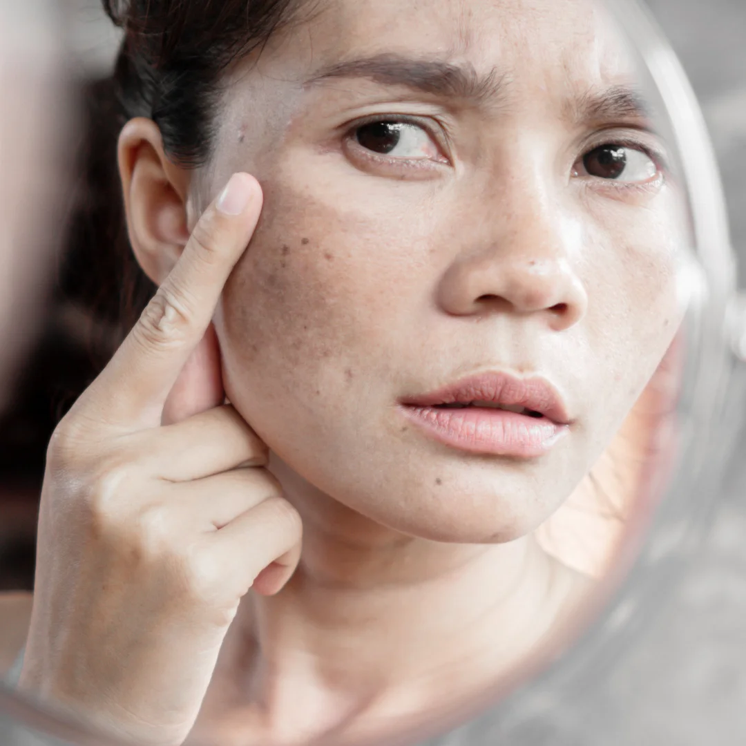 decoloration-due-a-lage