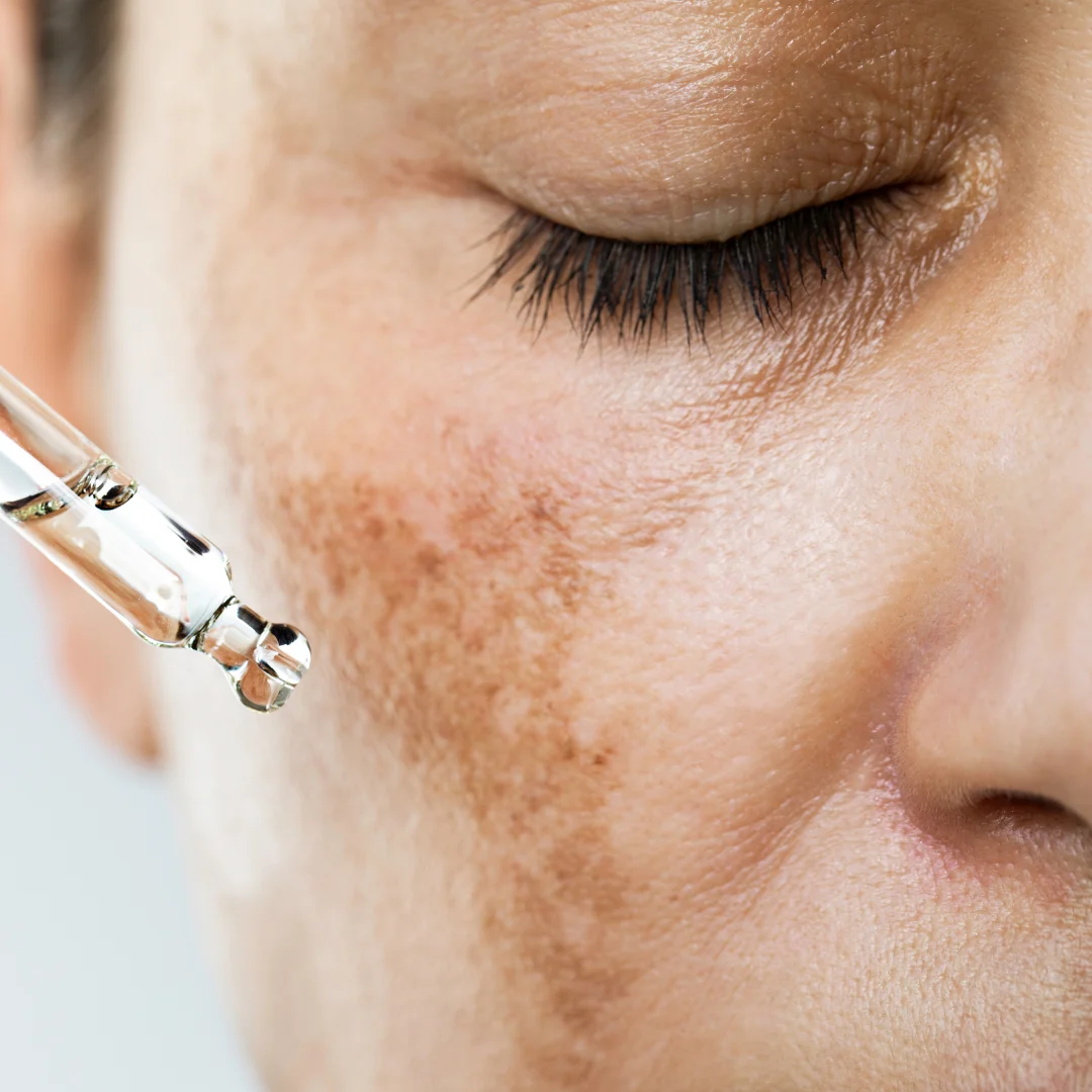 Hyperpigmentation 