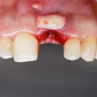 maladies-des-gencives-et-des-tissus-periapicaux