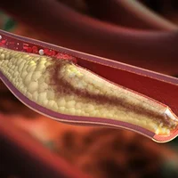 maladies-vasculaires-atherosclerose