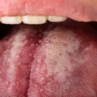 malformations-buccales