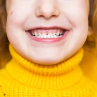 malocclusion-de-classe-i-ii-ou-iii