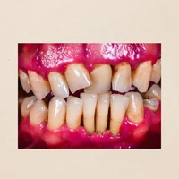 parodontite-infection-des-tissus-de-soutien-des-dents