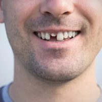 perte-de-dents-suite-a-un-accident-ou-un-traumatisme-facial