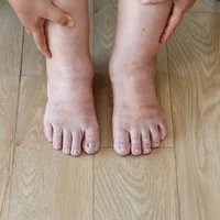 syndrome-douloureux-regional-complexe