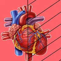 Syndrome du cœur gauche hypoplasique