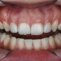 gingivale-retraction-des-gencives