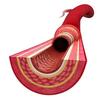 Hématome disséquant 