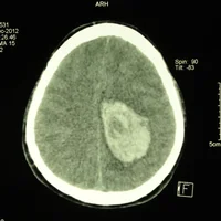 hematomes-intracraniens
