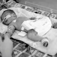 Accouchement prématuré