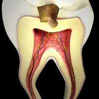 affections-de-la-pulpe-dentaire