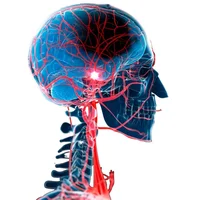 Accident vasculaire cérébral (AVC)