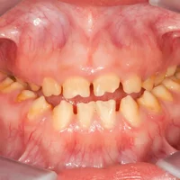 Amélogenèse imparfaite