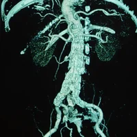 Anévrismes aortiques