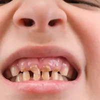 anodontie-absence-congenitale-de-dents