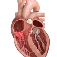 Incompétence tricuspidienne 