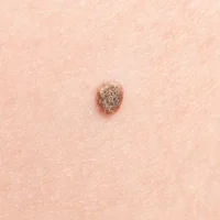 Carcinome épidermoïde