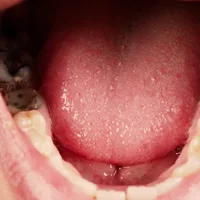 caries-dentaires-graves