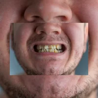 coloration-intrinseque-des-dents