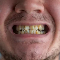 dents-decolorees-ou-tachees