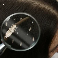 Infestation par les poux 