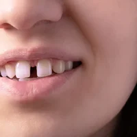 diastemes-espaces-entre-les-dents