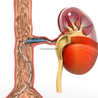 Embolie gazeuse artérielle