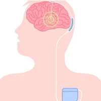 choree-de-huntington