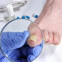 Dystrophie des ongles