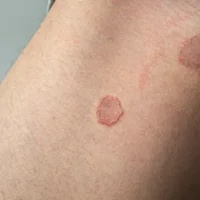 Eczéma marginé de hebra (l'intertrigo inguinal)