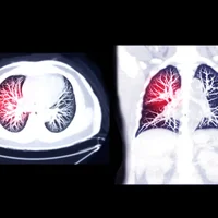 embolie-pulmonaire-ep