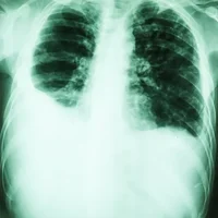 epanchement-pleural