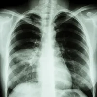 pneumopathie-dhypersensibilite