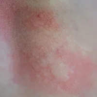 Érythème polymorphe