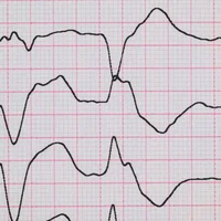 Extrasystoles ventriculaires