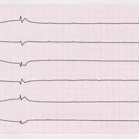Fibrillation ventriculaire