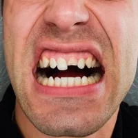 fracture-de-la-dent-causee-par-un-traumatisme