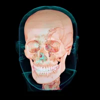 fractures-de-la-machoire