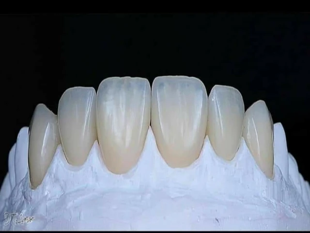 Cabinet hollywood smile