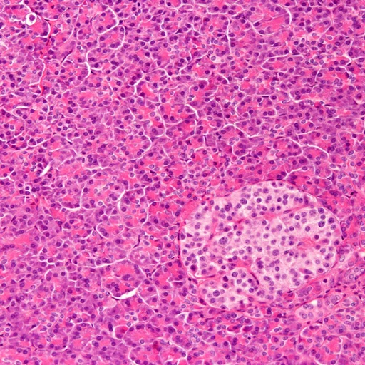 Histiocytose à cellules de Langerhans