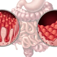 Maladies de l'intestin grêle