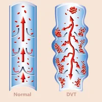 Thrombose veineuse profonde