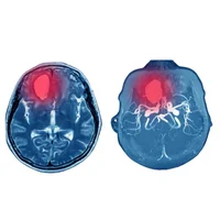 Abcès épidural intracrânien