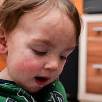 Allergies cutanées chez les enfants