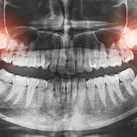 Anomalie du développement structurel des dents