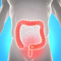 Cancer colorectal