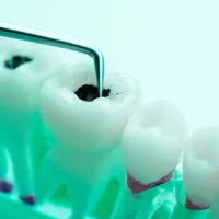 caries-dentaires