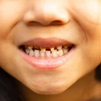 Caries dentaires chez les enfants