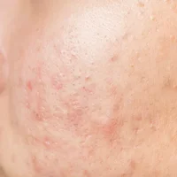 Cicatrices d'acné