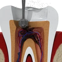 Complications après un traitement endodontique